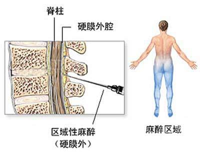 剖腹产