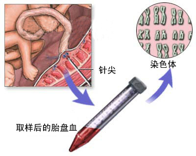 下面是胎儿脐带血取样图文介绍