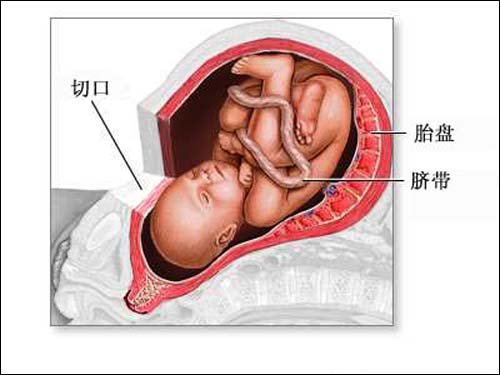 图解剖腹产手术