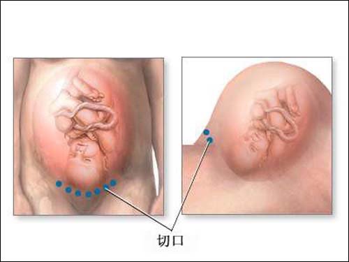 图解剖腹产