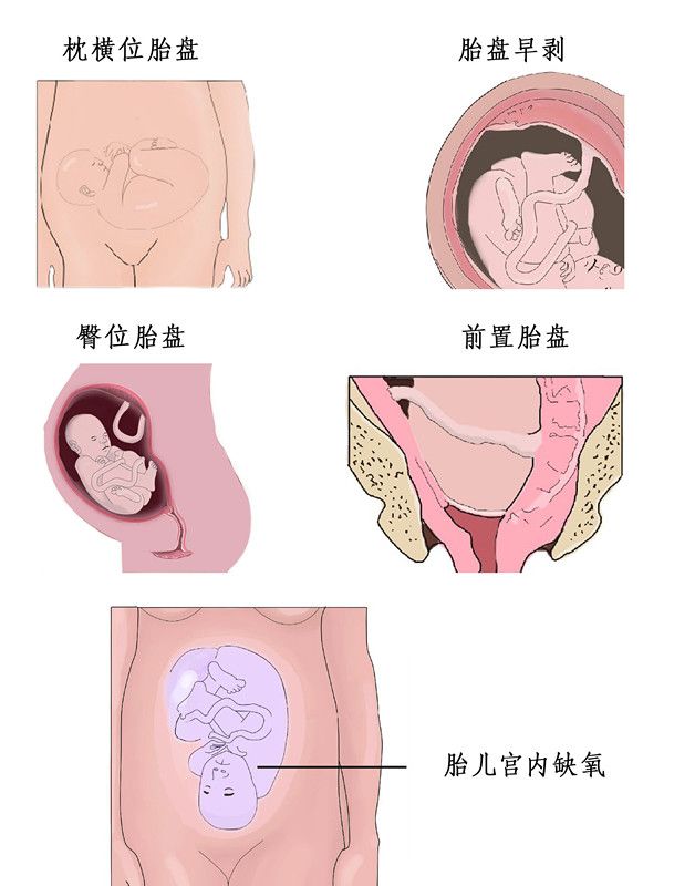 剖腹产分娩必知：整个剖腹产手术全过程图片