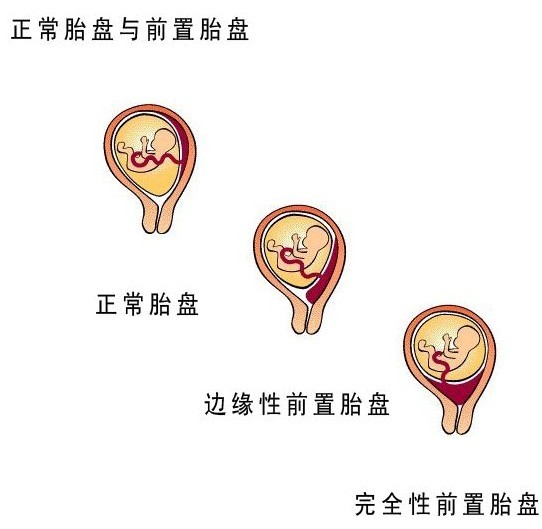 胎位不正的原因 胎位不正的纠正方法及时间