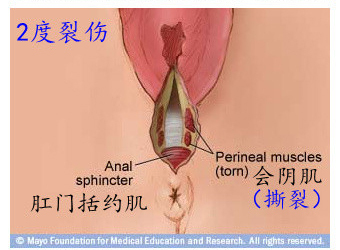 顺产分娩时刻 会阴撕裂损伤分级示意图