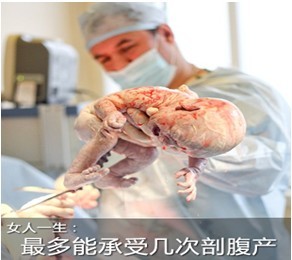 剖腹产分娩 女人一生最多能承受几次？