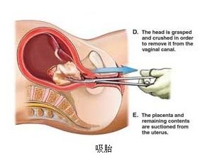 高清实拍:女人堕胎手术全过程(图片)