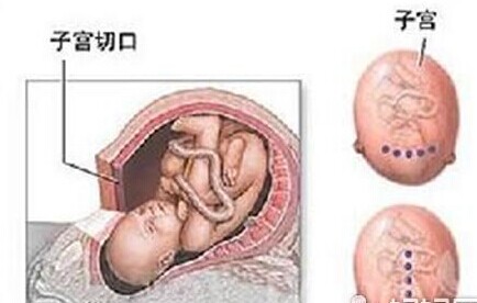 剖腹产后怀孕四月子宫破裂 胎死腹中